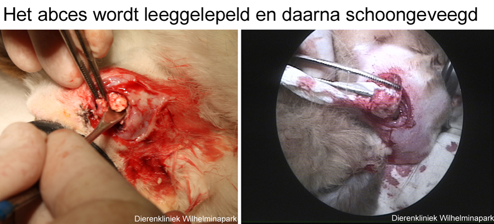 De opengemaakte abcesholte wordt leegegelepeld en schoongeveegd